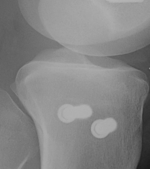 Tibial Plateau Schatzker 1 Percutaneous screws Lateral